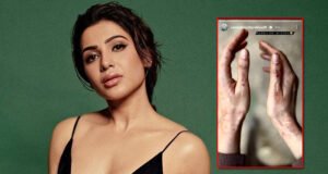 Citadel: Samantha Ruth Prabhu Gets Bruises While Shooting Action Scenes!