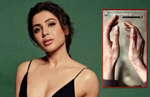 Citadel: Samantha Ruth Prabhu Gets Bruises While Shooting Action Scenes! Citadel: Samantha Ruth Prabhu Gets Bruises While Shooting Action Scenes!